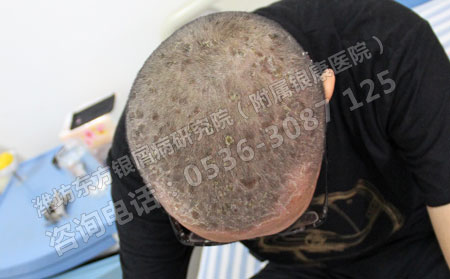 兒童銀屑病春季護(hù)理四不宜