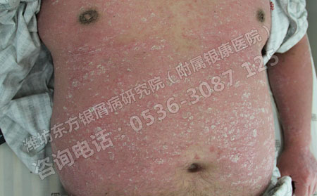 銀屑病如何正確診斷