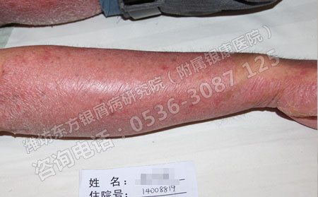 五一去濰坊銀屑病醫院治療怎么提前預約