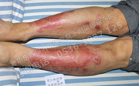 天氣轉(zhuǎn)暖 銀屑病患者的護(hù)理要做出哪些改變