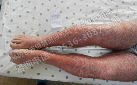 春季怎樣才能預防銀屑病的發生和復發