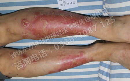 到了夏天銀屑病可以不治療自己好的嗎