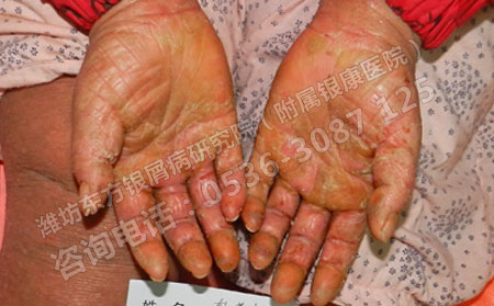 關節型銀屑病患者關節部位突然腫脹怎么辦