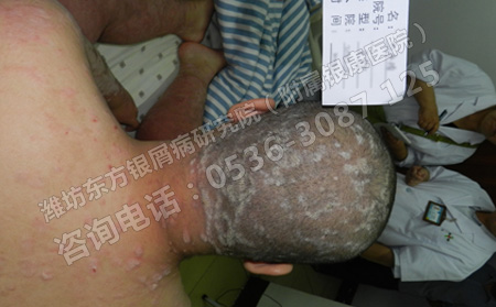 目前銀屑病的治療還存在哪些方面的誤區呢