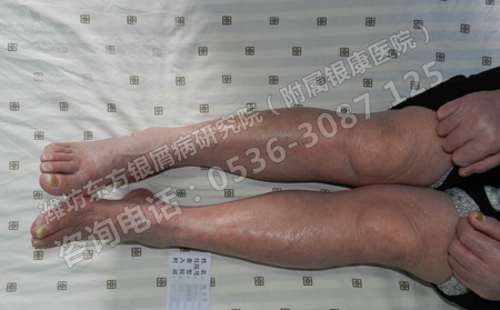 臨床上怎樣治療銀屑病才能避免復發