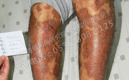 老人出現銀屑病怎么辦