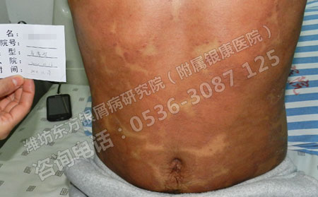 治銀屑病可以不可以關鍵是看你怎么做