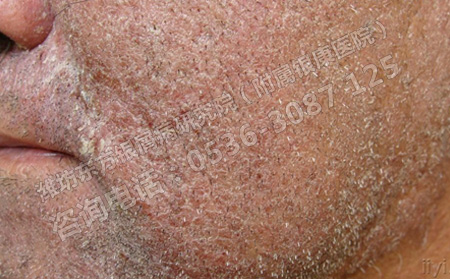 夏季來臨銀屑病患者如何把握治療時機呢