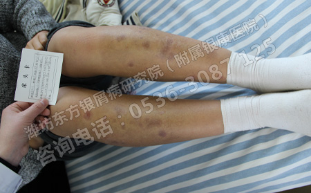 兒童銀屑病護理的四大技巧