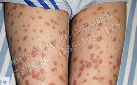 天氣炎熱難以忍受看尋常型銀屑病患者巧度夏季