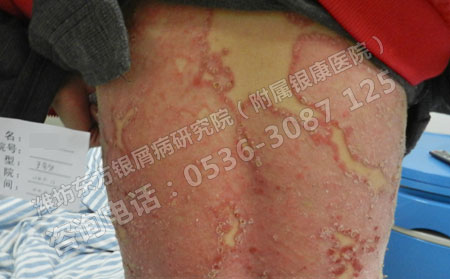 據說夏季不用治銀屑病也會可以真的是這樣嗎