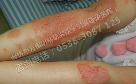 濰坊治療牛皮癬的醫院哪家實力強一些