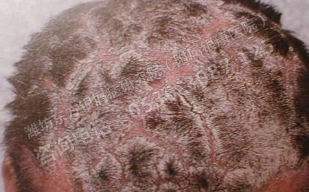 頭部得了銀屑病怎么護理好的快