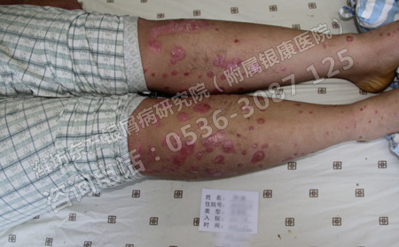 常年患銀屑病還會好的嗎