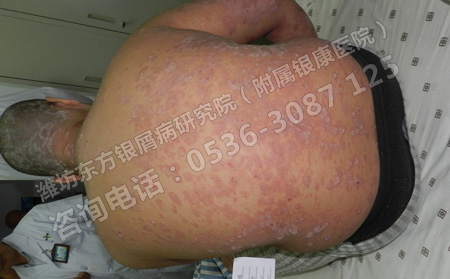 夏季銀屑病患者不能忽視的護理工作