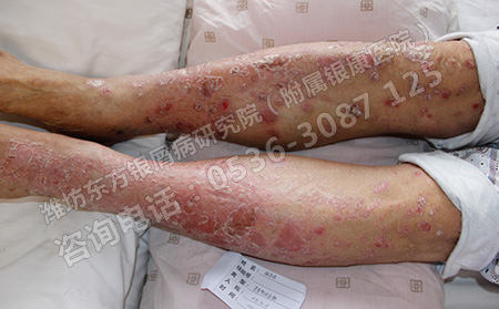 能夠影響牛皮癬治療效果的因素有哪些?