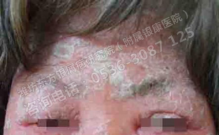 女性銀屑病患者在妊娠期要如何護理