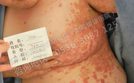 濰坊哪家醫院能看可以牛皮癬