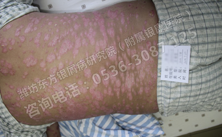 夏季來臨天干氣躁銀屑病患者如何做好護理工作