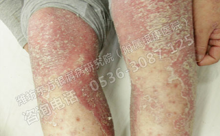 天氣炎熱銀屑病出沒注意細(xì)節(jié)防患于未然