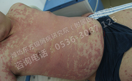 牛皮癬發病后若是沒能及時治療會有什么危害