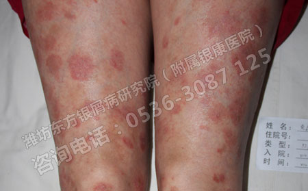 哪些女性更容易患上牛皮癬這種疾病呢