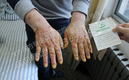 治療銀屑病的要點都有哪些呢