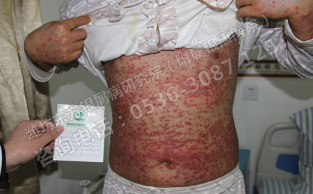 銀屑病患者怎樣才能做到健康合理飲食呢