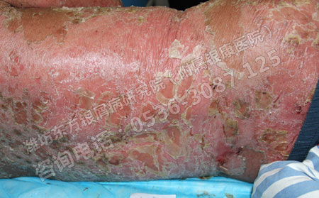 銀屑病惡化泛發全身的原因有哪些