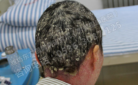 銀屑病患者夏天護(hù)理特別有效的方法