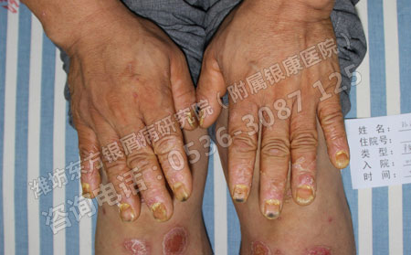 銀屑病病情嚴重，患者如何防止病情惡化？