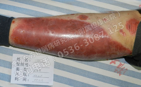 紅皮型牛皮癬不常見發(fā)病時(shí)有什么特點(diǎn)