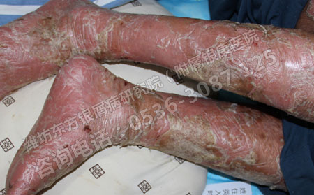 膿皰型牛皮癬怎樣護理皮膚會比較好？