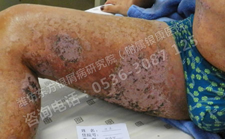 夏季除屑大作戰，如何讓銀屑病治療更有效