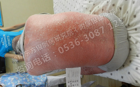 為什么銀屑病總是久治不愈反復(fù)出現(xiàn)呢