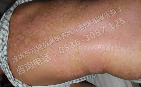 炎熱的夏季銀屑病患者如何做好日常護理工作