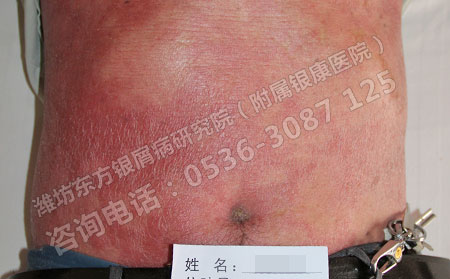 紅皮型銀屑病如何做好日常護(hù)理