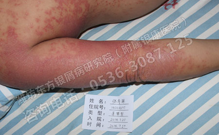 悶熱天氣銀屑病患者要如何應對比較好呢