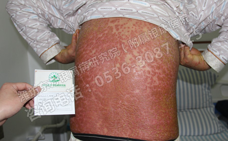 怎么治療牛皮癬才能在夏天的時候不留印兒