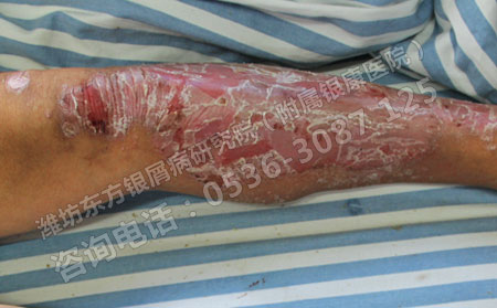 夏季小心促使銀屑病再次出現(xiàn)的問題