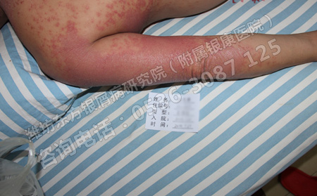 濰坊專門治療牛皮癬的是哪家醫院