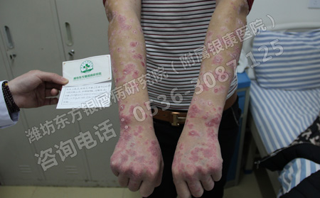 銀屑病患者的夏季護理尤其注意這幾點