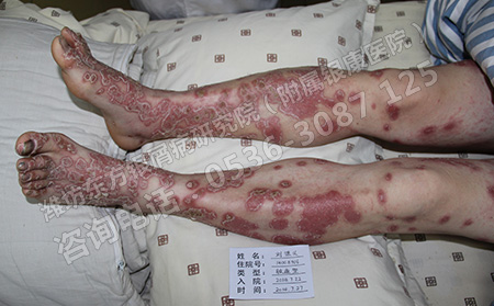 病情嚴重的銀屑病會不會傳染呢