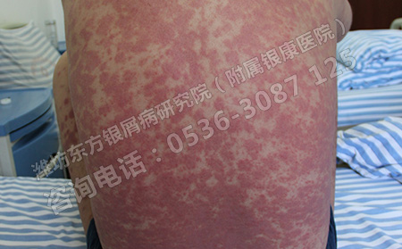 季節更替哪些因素容易誘發銀屑病呢