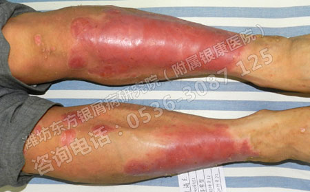 銀屑病夏季再次出現可能是因為哪些方面造成的