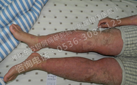 銀屑病夏季恢復(fù)就不能犯這些護(hù)理錯(cuò)誤