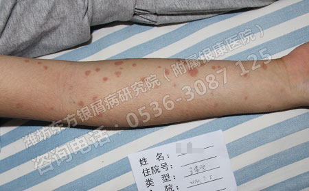 六一將至好的兒童牛皮癬還孩子健康童年