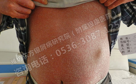 銀屑病患者的病情難以恢復的主要原因