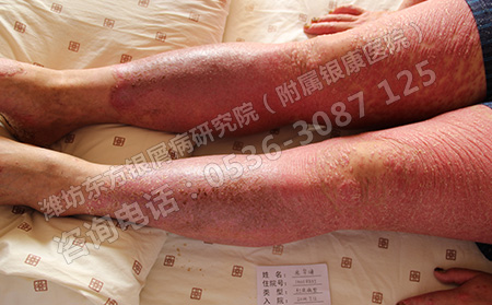 得了銀屑病經久不愈去濰坊哪里能好的呢