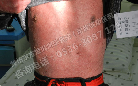 去濰坊市里那個皮膚病醫院看牛皮癬可以點